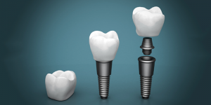 New Trends In Dental Implants