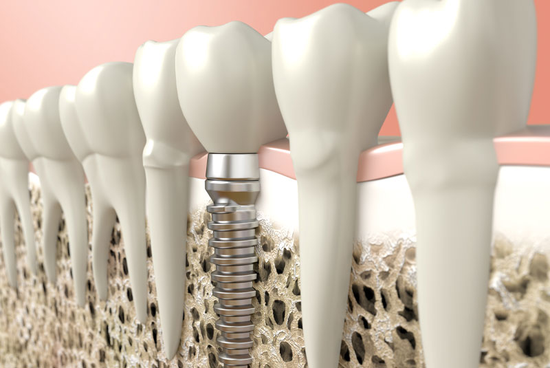 dental implant model