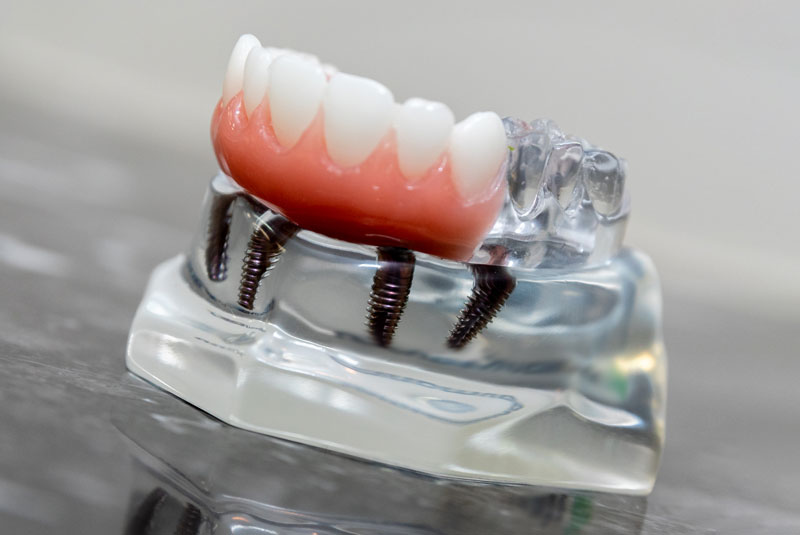 full arch implant model on counter