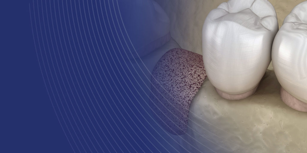 jawbone prepared for implant with bone graft