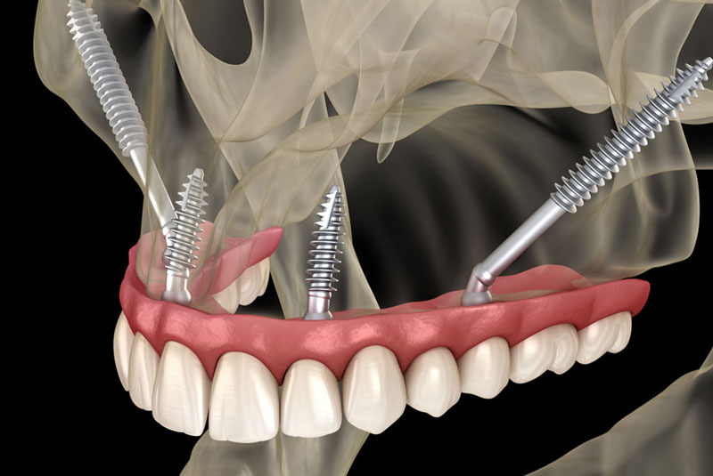 zygomatic dental implants model